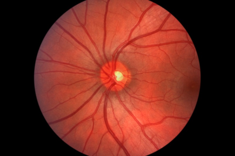 Glaucoma  Lander, WY 